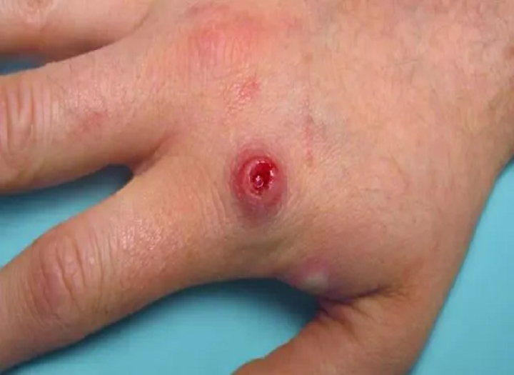 Monkeypox'u anlama ve nasıl önleneceğini？
